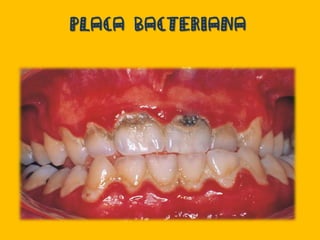 PLACA BACTERIANA
 