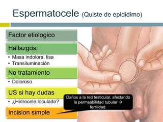 Espermatocele (Quiste de epididimo) 
Stephen M. (2010). Common Scrotal and Testicular Problems. 
Prim Care Clin Office Pract 37; 618–619 
Factor etiologico 
Hallazgos: 
• Masa indolora, lisa 
• Transiluminación 
No tratamiento 
• Doloroso 
US si hay dudas 
• ¿Hidrocele loculado? 
Incision simple 
 