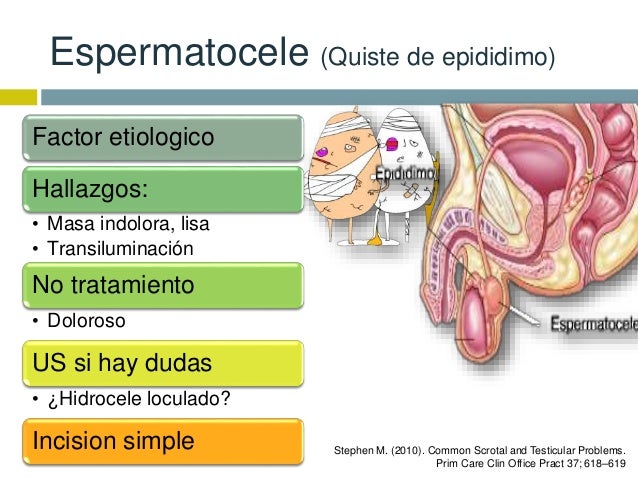Espermatocele y varicocele