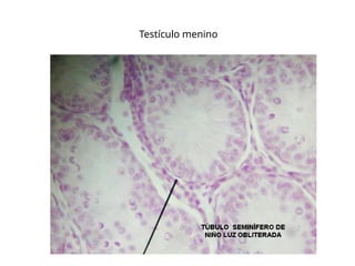 Testículo menino
 
