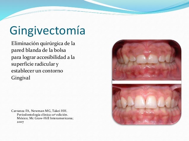Periodontologia clinica carranza 10 edicion pdf printer