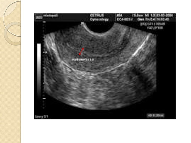 Espessamento endometrial à ultrassonografia e achados