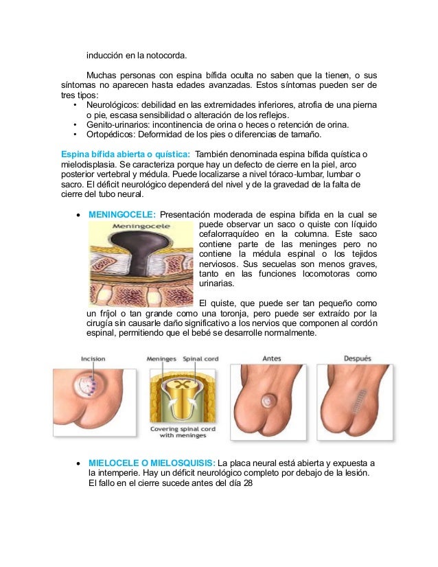 malformaciones de la médula espinal