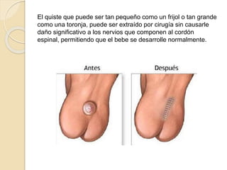 El quiste que puede ser tan pequeño como un frijol o tan grande 
como una toronja, puede ser extraído por cirugía sin causarle 
daño significativo a los nervios que componen al cordón 
espinal, permitiendo que el bebe se desarrolle normalmente. 
 