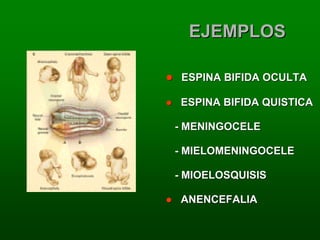 EJEMPLOS

 ESPINA BIFIDA OCULTA

ESPINA BIFIDA QUISTICA

- MENINGOCELE

- MIELOMENINGOCELE

- MIOELOSQUISIS

ANENCEFALIA
 