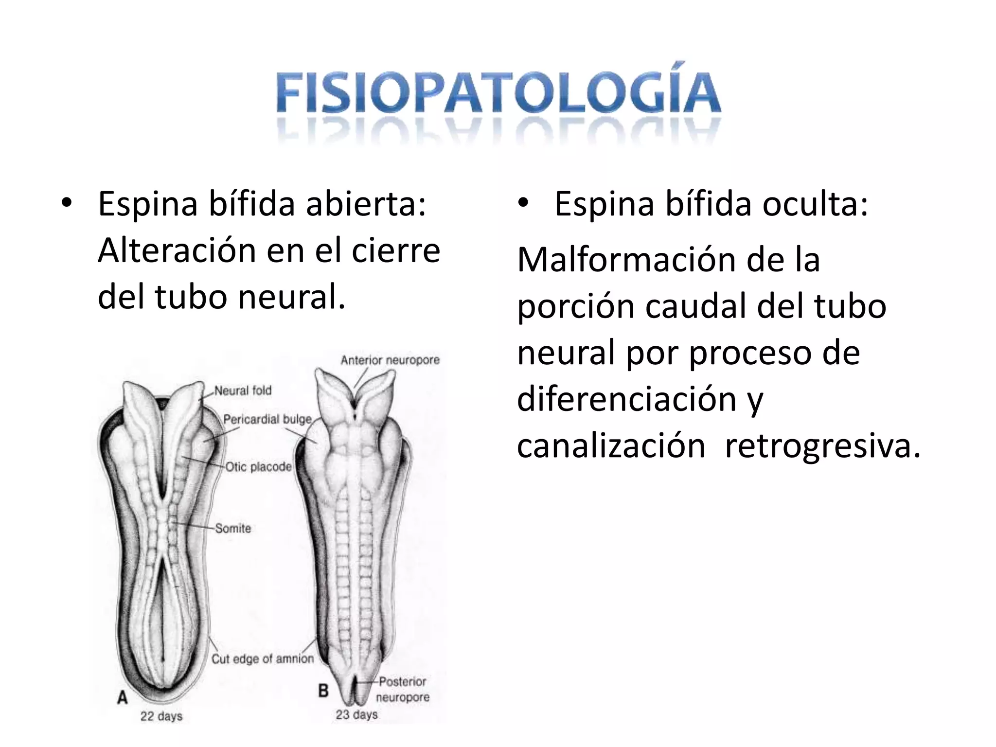 Espina bifida | PPTX