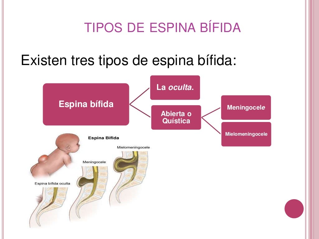 Espina bifida
