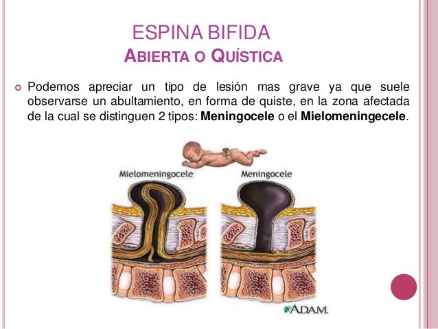 Espina Bífida Quística: