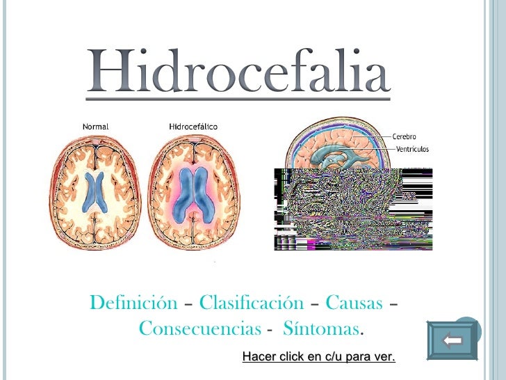 Espina bifida e hidrocefalia Espina bifida e hidrocefalia