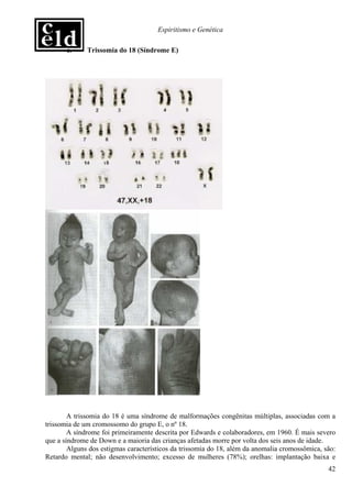 Espiritismo e Genética

       c.     Trissomia do 18 (Síndrome E)




        A trissomia do 18 é uma síndrome de malformações congênitas múltiplas, associadas com a
trissomia de um cromossomo do grupo E, o nº 18.
        A síndrome foi primeiramente descrita por Edwards e colaboradores, em 1960. É mais severo
que a síndrome de Down e a maioria das crianças afetadas morre por volta dos seis anos de idade.
        Alguns dos estigmas característicos da trissomia do 18, além da anomalia cromossômica, são:
Retardo mental; não desenvolvimento; excesso de mulheres (78%); orelhas: implantação baixa e
                                                                                                42
 