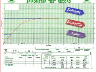 1,8
5
1,032
1,032
1,032
1,857
5,16
4,4
5,1
42%
101%
1,0321 5,1
1,857 5,16 36%
20%FEF 25-75%
25 1,72 M
32º
 