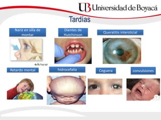 Tardías
Nariz en silla de
montar
Dientes de
Hutchinson
Queratitis intersticial
CegueraRetardo mental hidrocefalia convulsiones
 