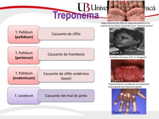 Treponema
T. Pallidum
(pallidium)
T. carateum
T. Pallidum
(pertenue)
T. Pallidum
(endemicum)
Causante de sífilis
Causante de frambesia
Causante de sífilis endémica
(bejel)
Causante del mal de pinto
Frambesia (courtesy of Dr. O. Henggeler)
Treponematosis causada por un treponema
indistinguible del treponema pálido.
Llagas (lesiones) de sífilis en etapa secundaria en las
palmas de las manos. Conocido como "lesiones palmar".
Figura. 2
Figura.3
Figura.4 Mal de pinto
 