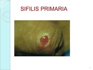 SIFILIS PRIMARIA
17
 