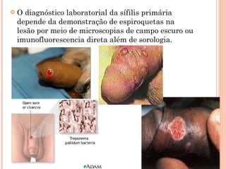 O diagnóstico laboratorial da sífilis primária depende da demonstração de espiroquetas na lesão por meio de microscopias de campo escuro ou imunofluorescencia direta além de sorologia. 