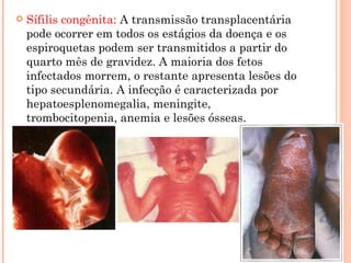 Sífilis congênita:  A transmissão transplacentária pode ocorrer em todos os estágios da doença e os espiroquetas podem ser transmitidos a partir do quarto mês de gravidez. A maioria dos fetos infectados morrem, o restante apresenta lesões do tipo secundária. A infecção é caracterizada por hepatoesplenomegalia, meningite, trombocitopenia, anemia e lesões ósseas. 