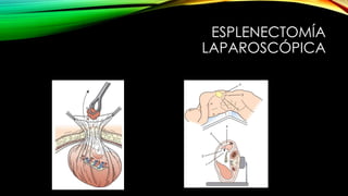 ESPLENECTOMÍA
LAPAROSCÓPICA
 