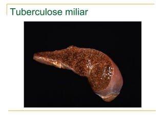 Tuberculose miliar
 