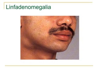 Linfadenomegalia
 