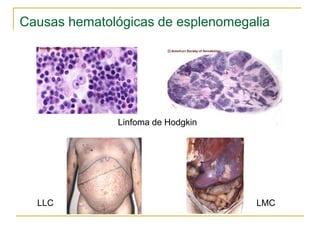 Causas hematológicas de esplenomegalia




              Linfoma de Hodgkin




  LLC                              LMC
 