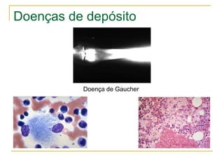 Doenças de depósito




          Doença de Gaucher
 
