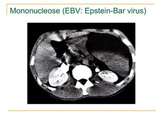 Mononucleose (EBV: Epstein-Bar virus)
 
