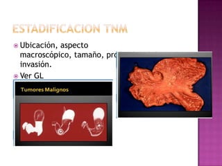  Ubicación,aspecto
  macroscópico, tamaño, profundidad de
  invasión.
 Ver GL
 