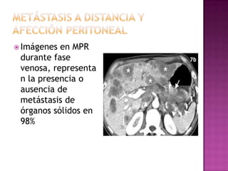  Imágenes en MPR
 durante fase
 venosa, representa
 n la presencia o
 ausencia de
 metástasis de
 órganos sólidos en
 98%
 