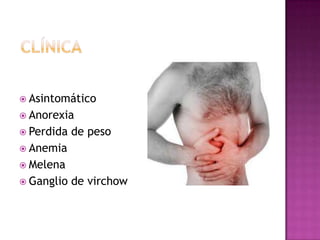  Asintomático
 Anorexia
 Perdida   de peso
 Anemia
 Melena
 Ganglio   de virchow
 