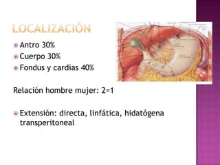  Antro30%
 Cuerpo 30%
 Fondus y cardias 40%


Relación hombre mujer: 2=1

 Extensión:directa, linfática, hidatógena
 t...