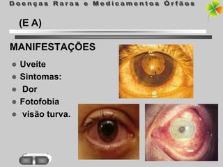 (E A)

MANIFESTAÇÕES
   Uveíte
   Sintomas:
   Dor
   Fotofobia
   visão turva.
 