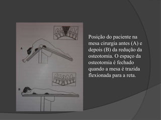 Posição do paciente na
mesa cirurgia antes (A) e
depois (B) da redução da
osteotomia. O espaço da
osteotomia é fechado
quando a mesa é trazida
flexionada para a reta.
 