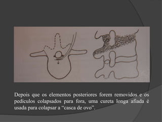 Depois que os elementos posteriores forem removidos e os
pedículos colapsados para fora, uma cureta longa afiada é
usada para colapsar a “casca de ovo”.
 