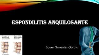 Espondilitis ANQUILOSANTE
Eguer Gonzales García
 