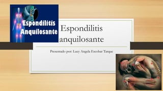 Espondilitis
anquilosante
Presentado por: Lucy Angela Escobar Tarque
 