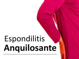 Espondilitis
Anquilosante
 