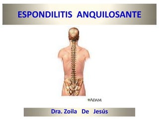 ESPONDILITIS ANQUILOSANTE




      Dra. Zoila De Jesús
 