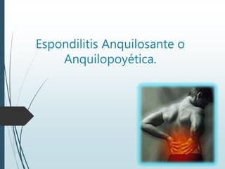 Espondilitis Anquilosante o
Anquilopoyética.
 