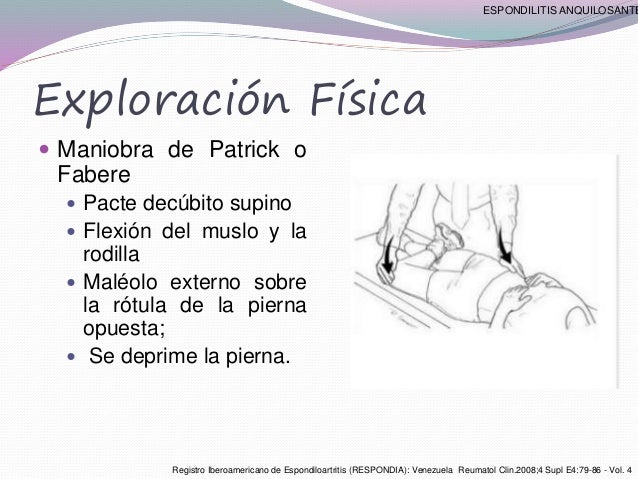 Espondilitis anquilosante