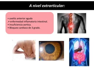 • uveítis anterior aguda
.• enfermedad inflamatoria intestinal.
• Insuficiencia aortica.
• Bloqueo cardiaco de 3 grado.
A nivel extrarticular:
 