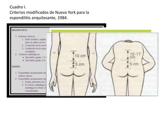 Cuadro I.
Criterios modificados de Nueva York para la
espondilitis anquilosante, 1984.
 