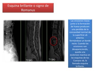 Esquina brillante o signo de
Romanus
Las erosiones óseas
junto a la formación
de hueso producen
una perdida de la
concavidad normal de
la superficie vb
anterior,
formándose un borde
recto. Cuando las
erosiones van
desapareciendo,
queda una
esclerosis reactiva en
las esquinas de los
Cuerpos vb, la
llamada esquina
brillante.
 