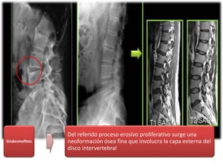 Sindesmofitos
Del referido proceso erosivo proliferativo surge una
neoformación ósea fina que involucra la capa externa del
disco intervertebral
 