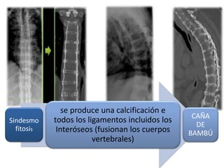 Sindesmo
fitosis
se produce una calcificación e
todos los ligamentos incluidos los
Interóseos (fusionan los cuerpos
vertebrales)
CAÑA
DE
BAMBÚ
 