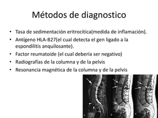 Métodos de diagnostico
• Tasa de sedimentación eritrocitica(medida de inflamación).
• Antígeno HLA-B27(el cual detecta el gen ligado a la
espondilitis anquilosante).
• Factor reumatoide (el cual debería ser negativo)
• Radiografías de la columna y de la pelvis
• Resonancia magnética de la columna y de la pelvis
 