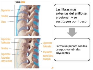 Las fibras más
externas del anillo se
erosionan y se
sustituyen por hueso
Forma un puente con los
cuerpos vertebrales
adyacentes
 