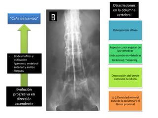 Osteoporosis difusa
Aspecto cuadrangular de
las vertebras
(más común en vértebras
torácicas): “squaring”
Destrucción del borde
osificado del disco
↓↓Densidad mineral
ósea de la columna y el
fémur proximal
“Caña de bambú”
Otras lesiones
en la columna
vertebral
Evolución
progresiva en
dirección
ascendente
- Sindesmofitos y
osificación
ligamento vertebral
anterior y anillos
fibrosos
 