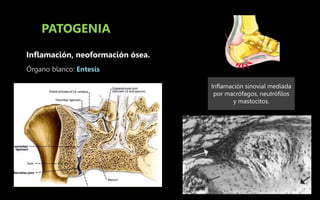 PATOGENIA
Inflamación, neoformación ósea.
Órgano blanco: Entesis
Inflamación sinovial mediada
por macrófagos, neutrófilos
y mastocitos.
 