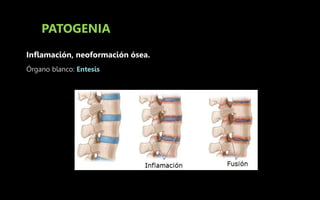 PATOGENIA
Inflamación, neoformación ósea.
Órgano blanco: Entesis
 