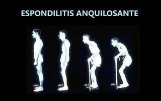 ESPONDILITIS ANQUILOSANTE
 